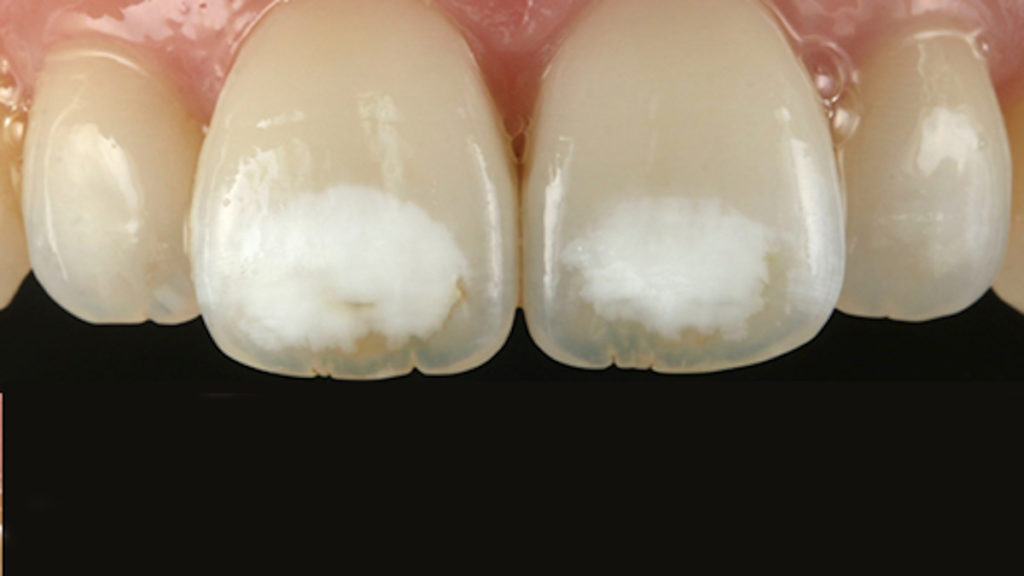 Qué son las manchas en los dientes