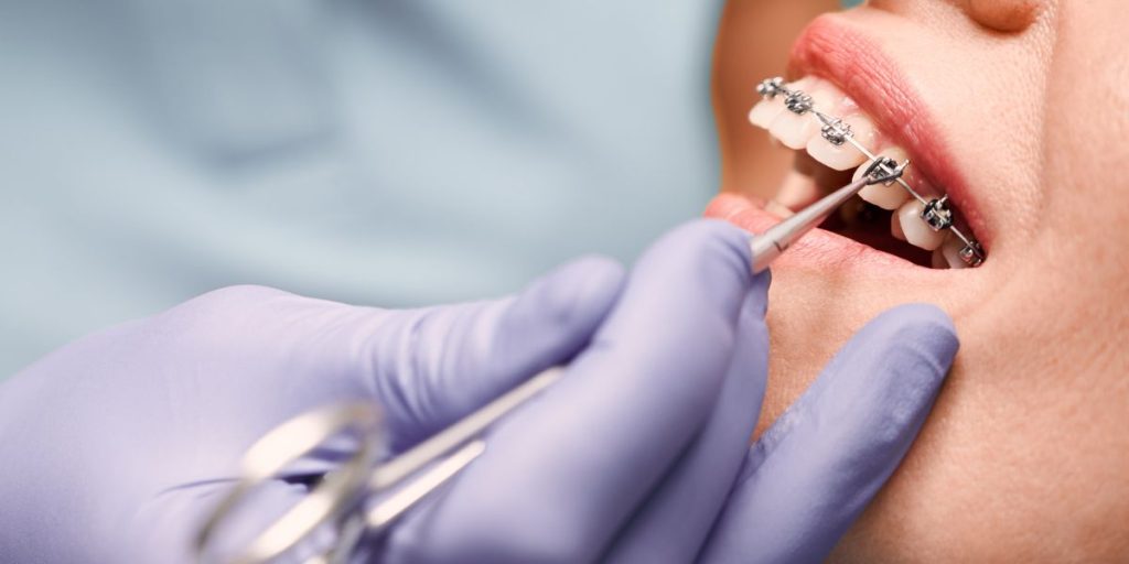 tratamiento-brackets-fuengirola