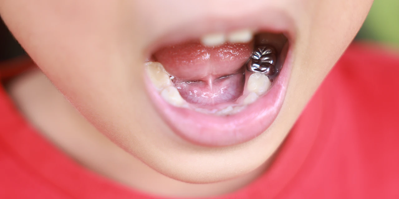 Mitos y realidades del frenillo, lo que necesitas saber antes de una frenectomía